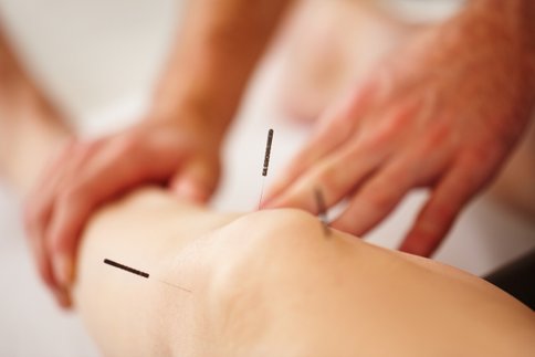 Medical Acupuncture Cornwall